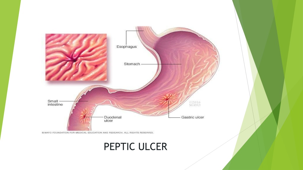 understanding peptic ulcers causes symptoms and dietary manageme