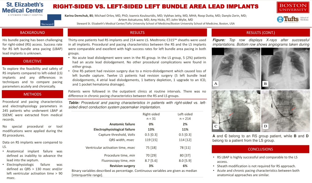 comparison of right sided vs left sided left bundle area lead implan