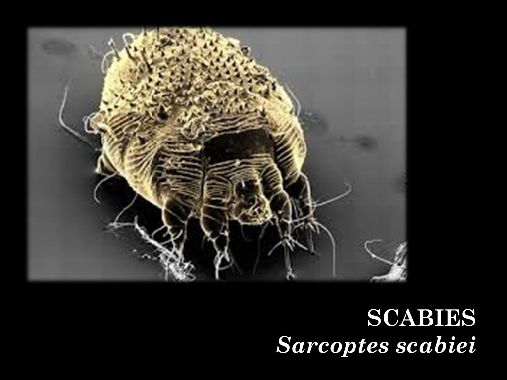 understanding scabies causes symptoms and treatme