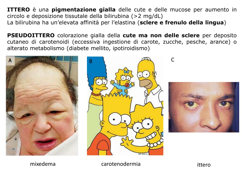 jaundice causes types and clinical consideratio