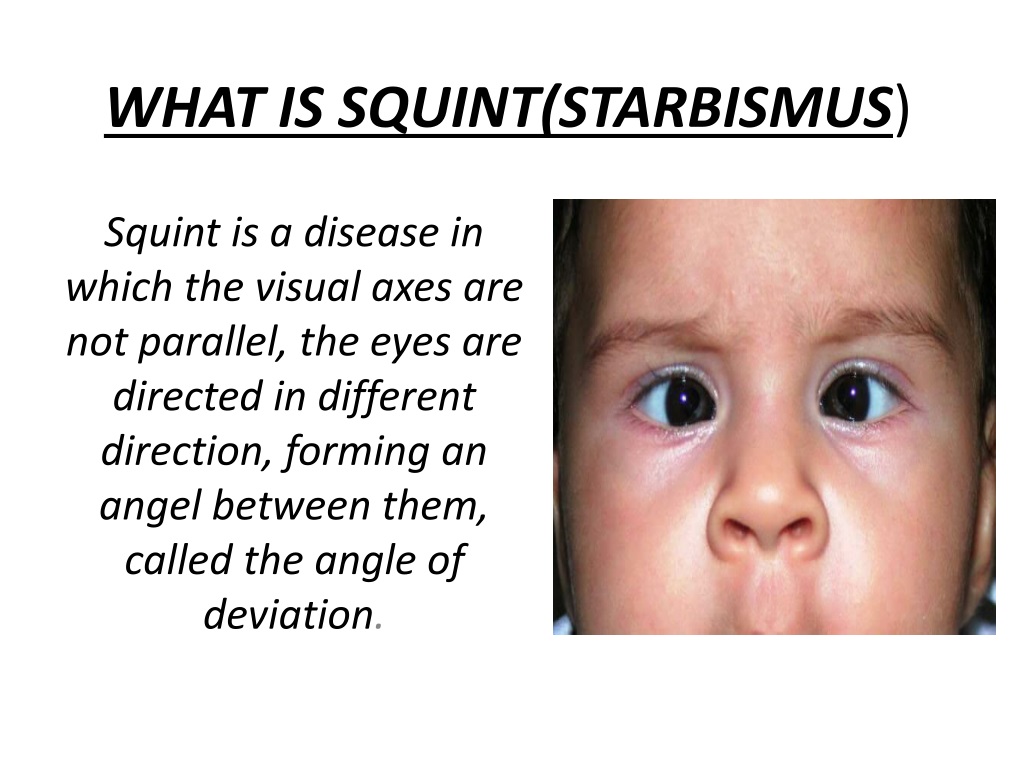 PPT - Understanding Squint (Starbismus) and Treatment Options ...