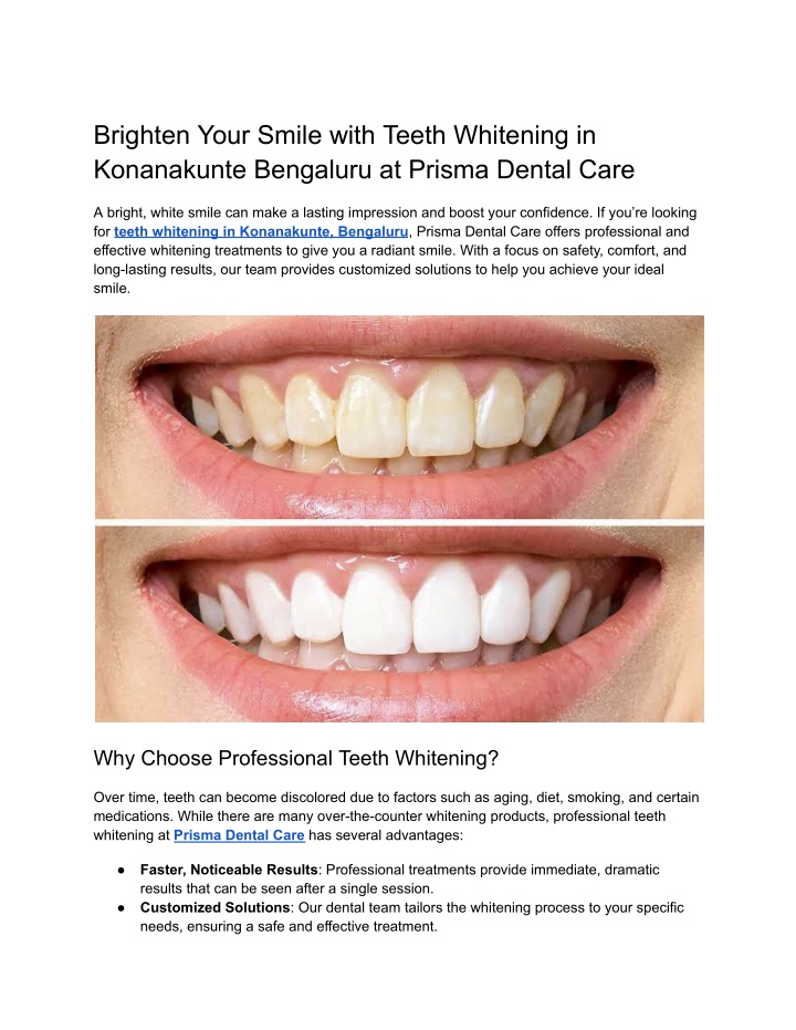 brighten your smile with teeth whitening