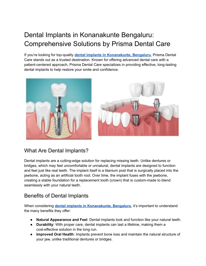 dental implants in konanakunte bengaluru