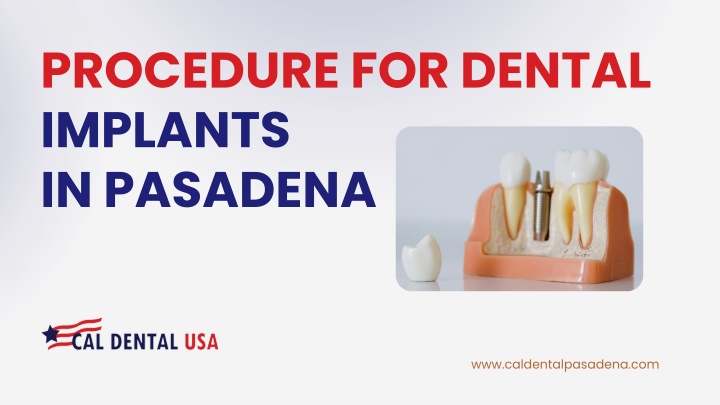 procedure for dental implants in pasadena