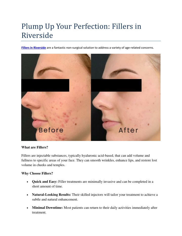 plump up your perfection fillers in riverside