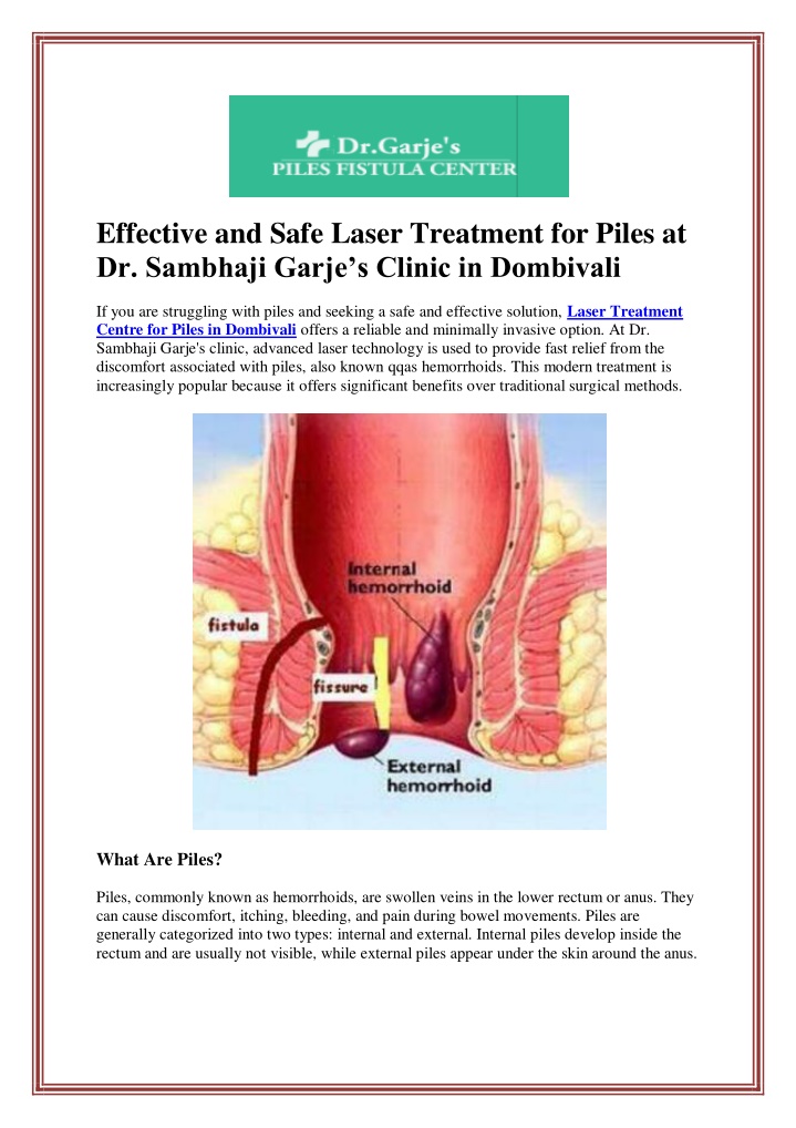 effective and safe laser treatment for piles