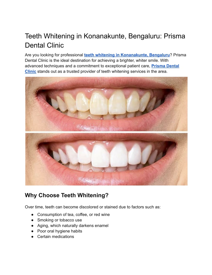 teeth whitening in konanakunte bengaluru prisma