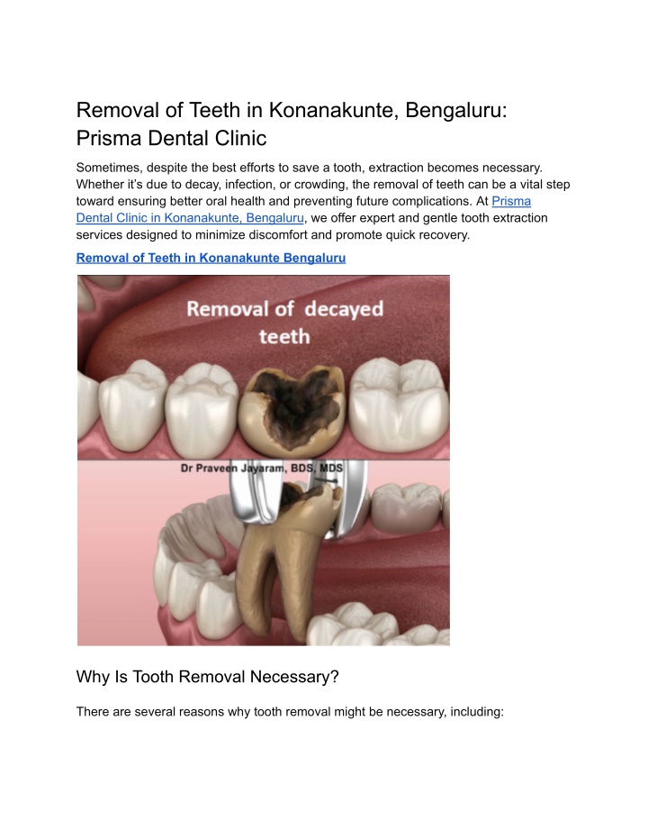 removal of teeth in konanakunte bengaluru prisma