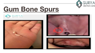 Gum Bone Spur - What It Is? and Pictures