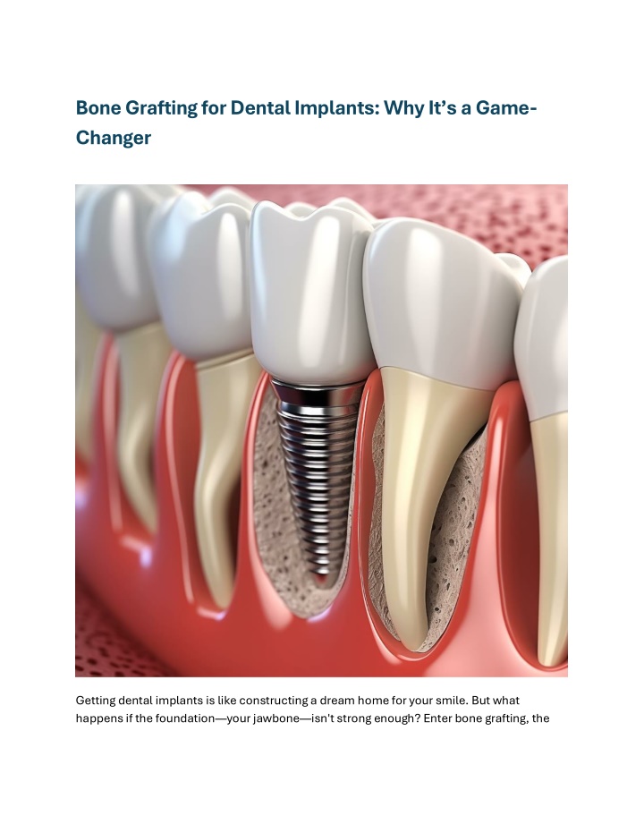 bone grafting for dental implants why it s a game