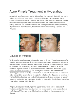 Acne Pimple Treatment in Hyderabad| Neoskin Clinic