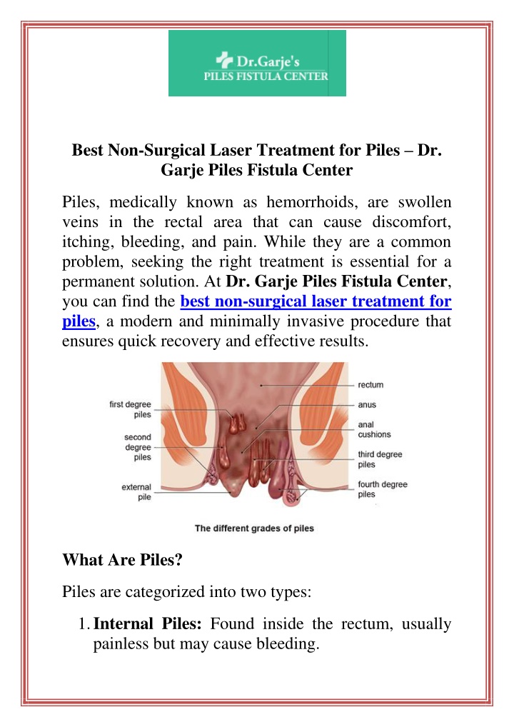 best non surgical laser treatment for piles