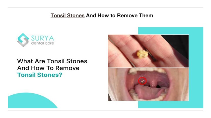 tonsil stones and how to remove them