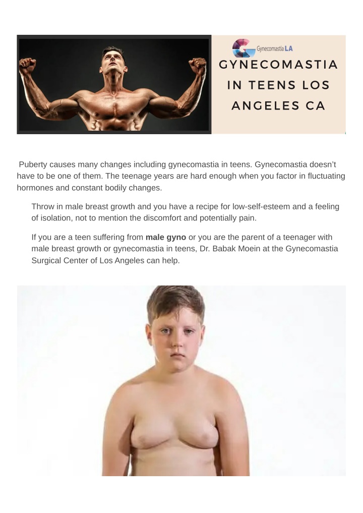 gynecomastia