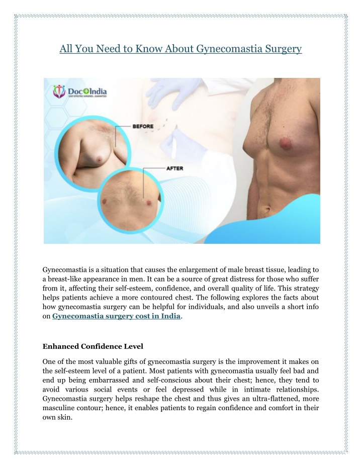 all you need to know about gynecomastia surgery