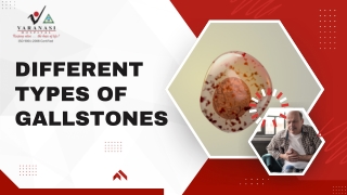 Different Types Of Gallstones