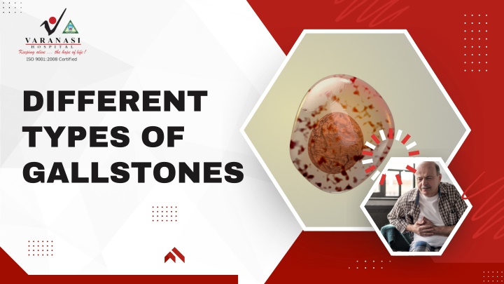 different types of gallstones