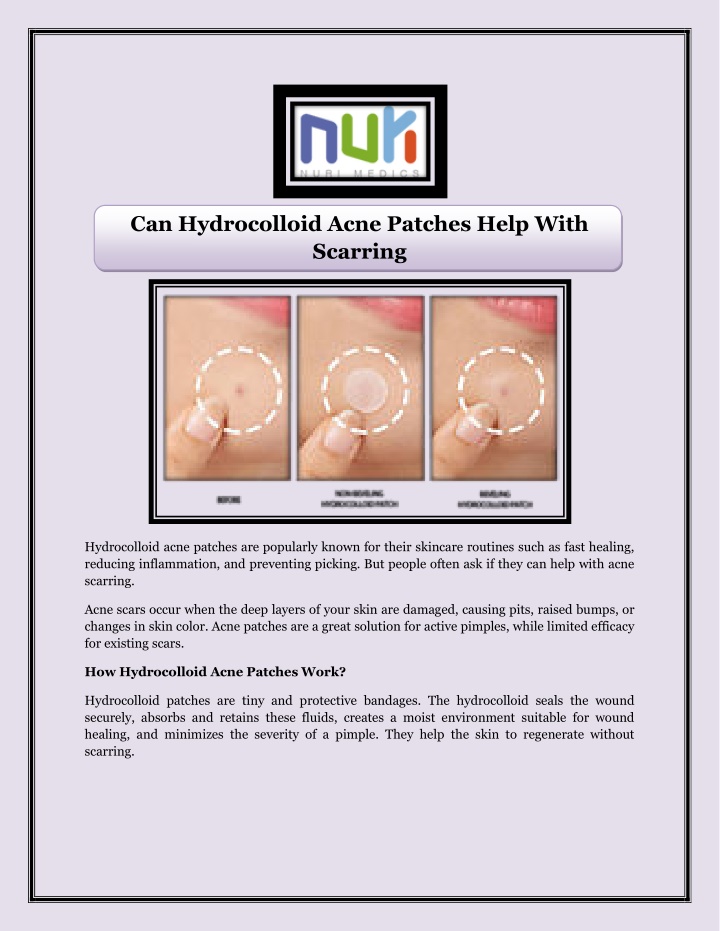 can hydrocolloid acne patches help with scarring