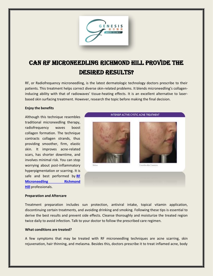 can rf microneedling richmond hill provide