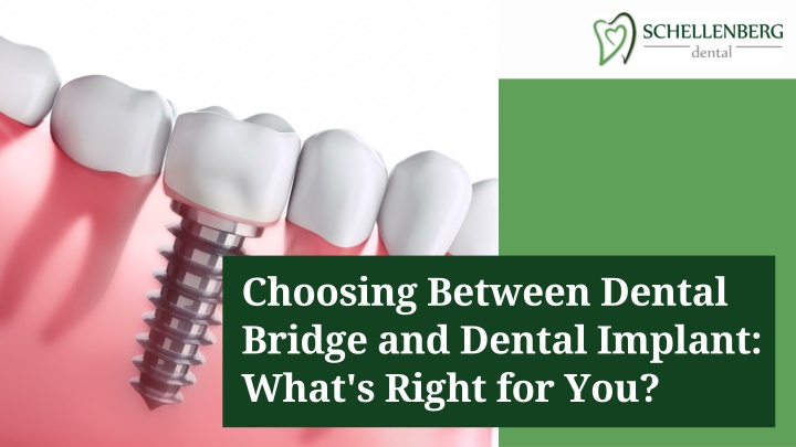 choosing between dental bridge and dental implant