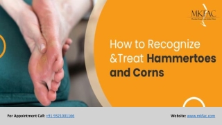 How to Recognize and Treat Hammertoes and Corns | MKFAC