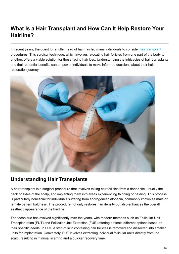 what is a hair transplant and how can it help