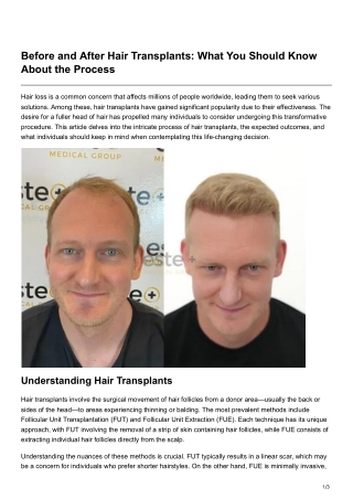 Before and After Hair Transplants What You Should Know About the Process