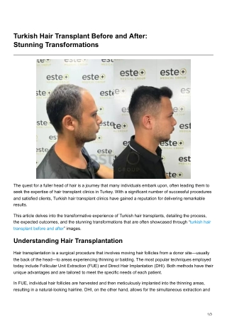 Turkish Hair Transplant Before and After Stunning Transformations
