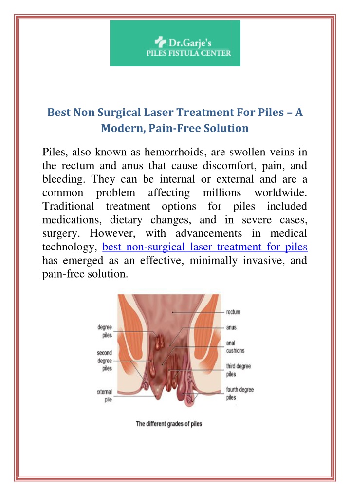 best non surgical laser treatment for piles