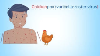 chicken pox varicella zoster virus