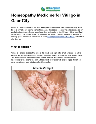 Homeopathy Medicine for Vitiligo in Gaur City