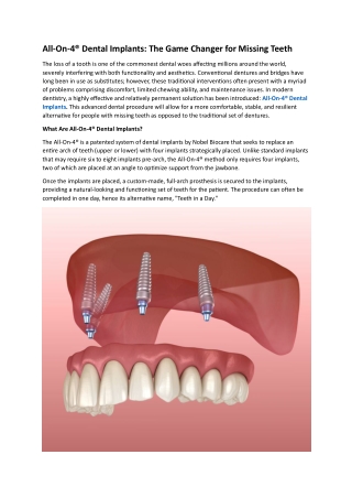 All-On-4® Dental Implants: The Game Changer for Missing Teeth