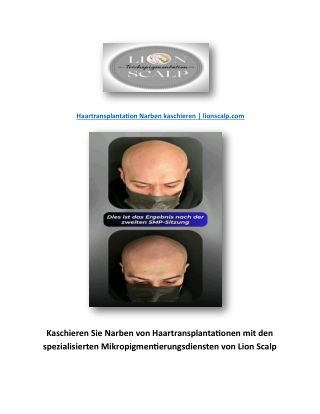 Haartransplantation Narben kaschieren | lionscalp.com