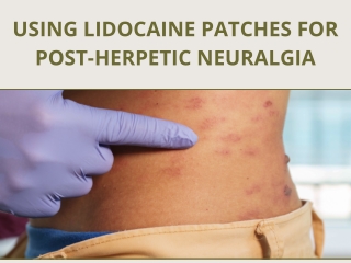using lidocaine patches for post herpetic