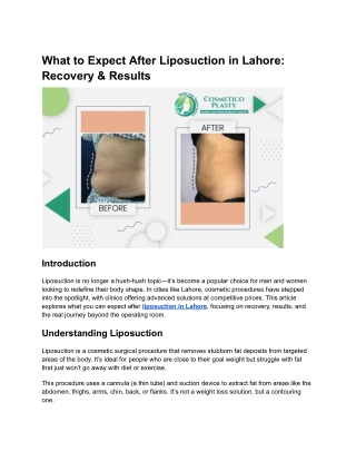 What to Expect After Liposuction in Lahore_ Recovery & Results